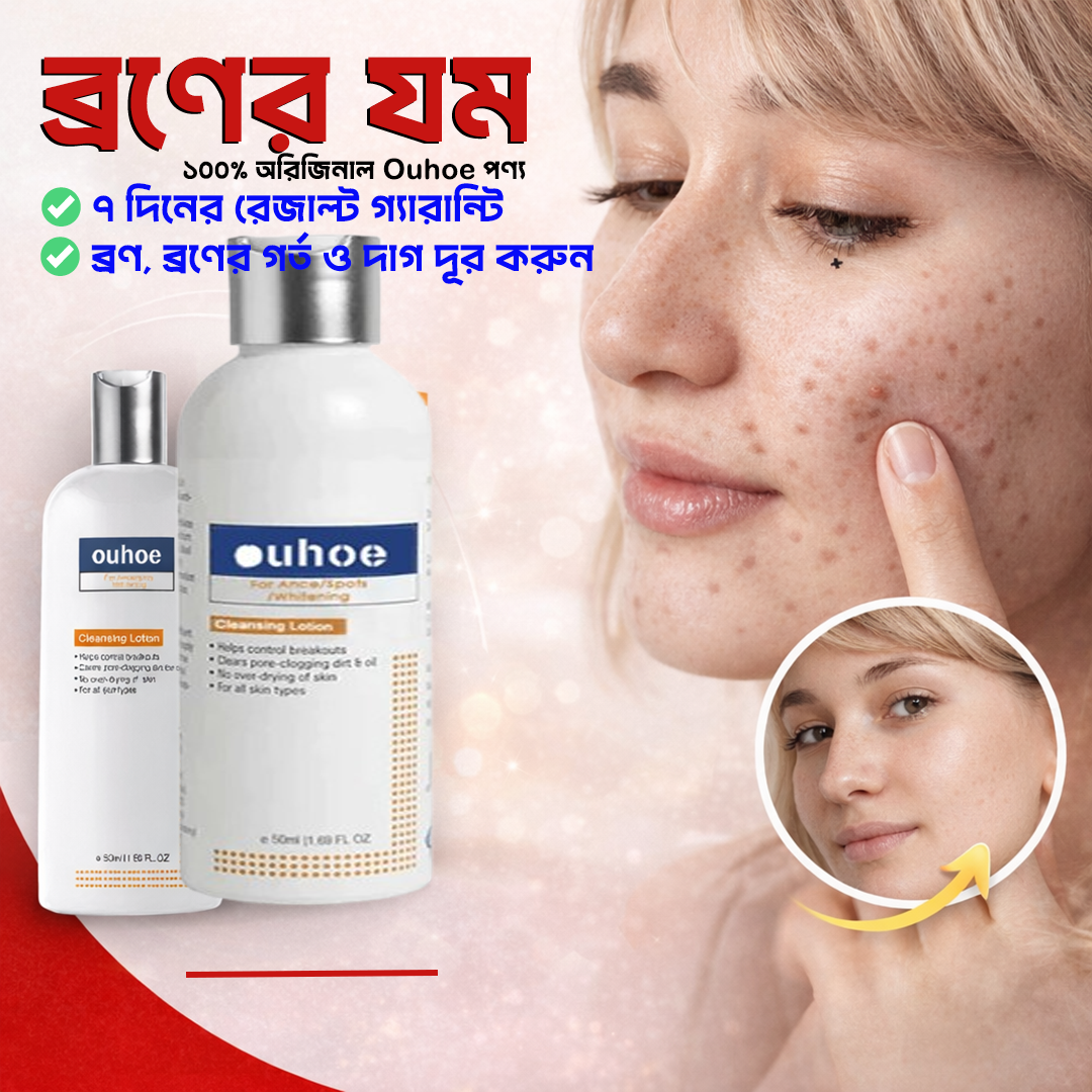 চায়না ouhoe ক্লিনজিং লোশন ব্রণ মেছতার যম !! ১ঘন্টার স্পেশাল অফার